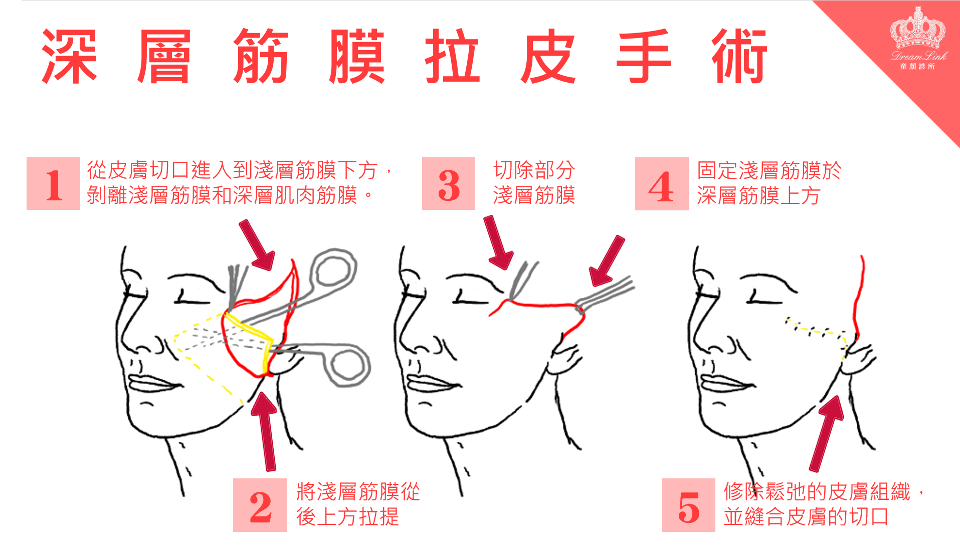 深層筋膜拉皮 深層筋膜拉皮